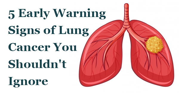 5 Early Warning Signs of Lung Cancer You Shouldn’t Ignore