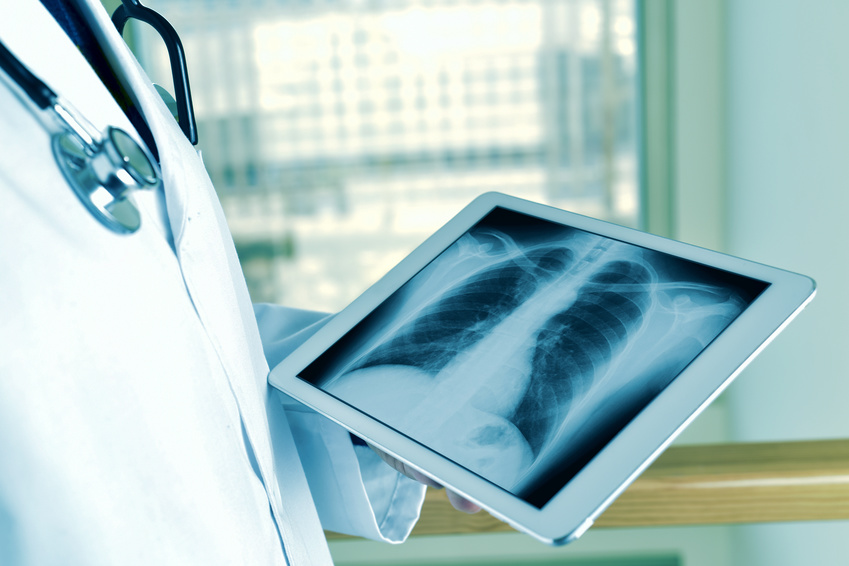 4 Myths About Lung Cancer You Should Not Believe to Save Your Health